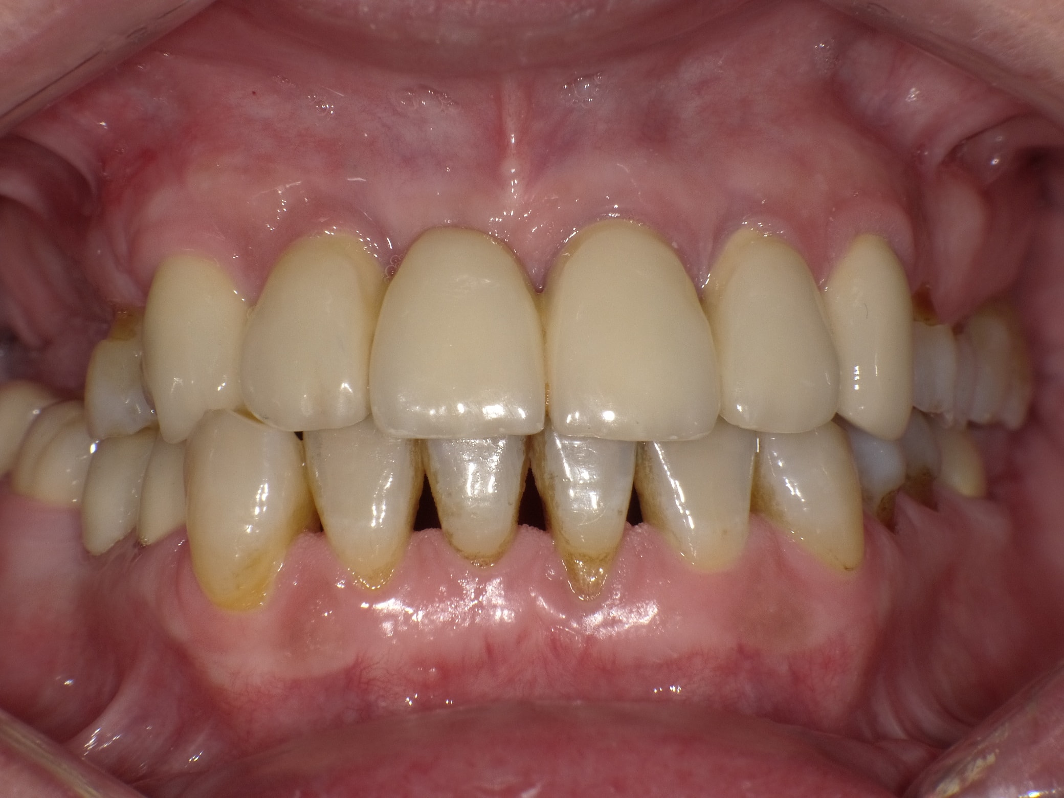 Fehlende Zähne und extremer Verschleiß durch intensives Zähneknirschen (Bruxismus)